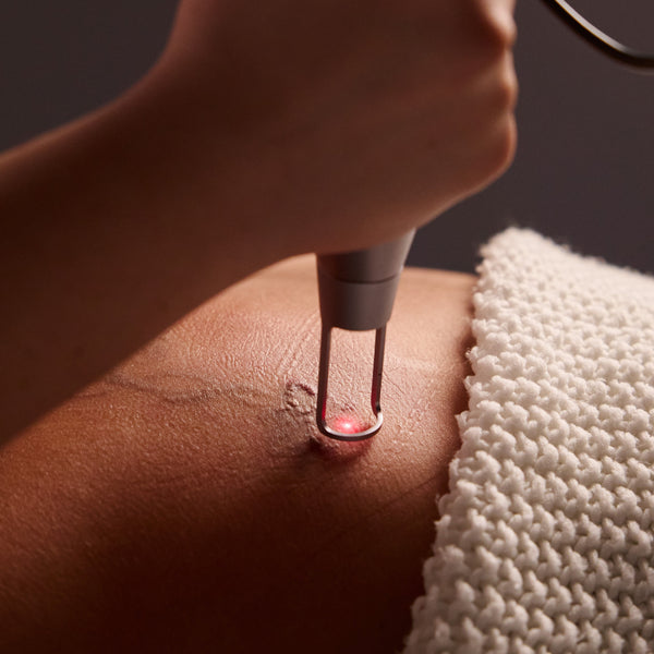 Eliminación de tatuajes